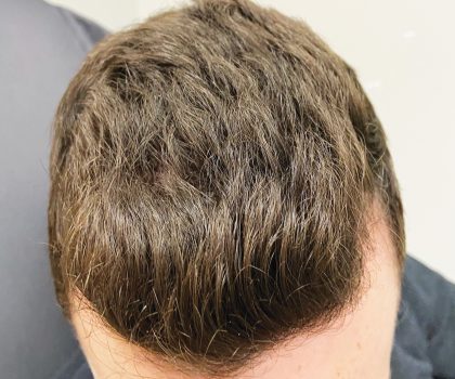 PRP is a medically-proven way to regrow hair using the body’s own platelet-rich plasma