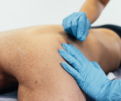 The benefits of dry needling